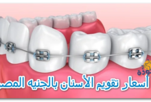 أسعار تقويم الأسنان بالجنيه المصري