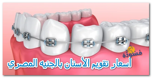 أسعار تقويم الأسنان بالجنيه المصري